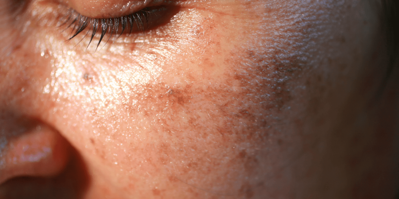 Solar lentigines on a woman's face